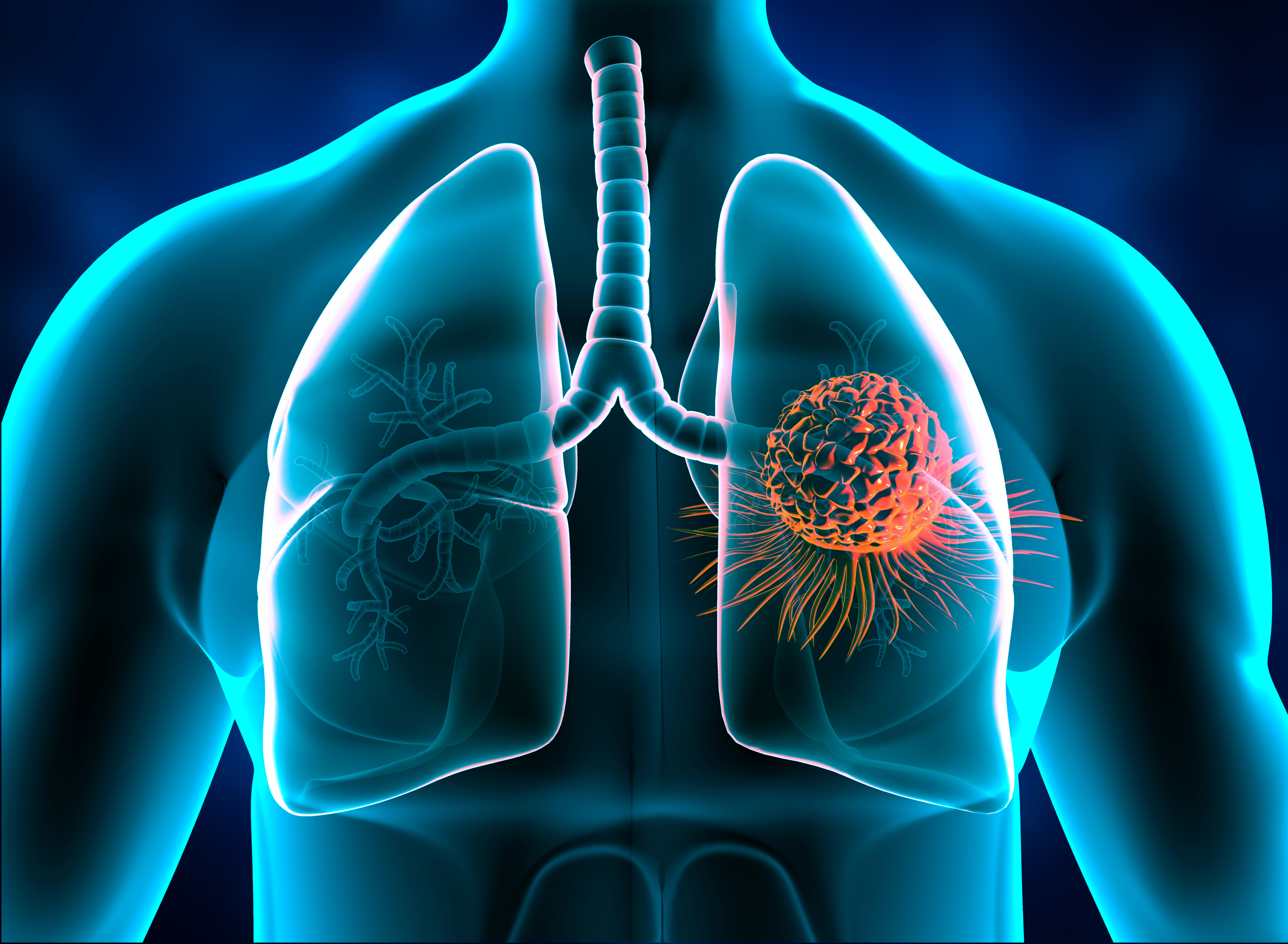 Cancer du poumon : ce que vous devez savoir - Stop-tabac.ch
